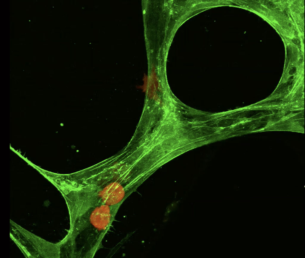 tumor cell leaving blood stream