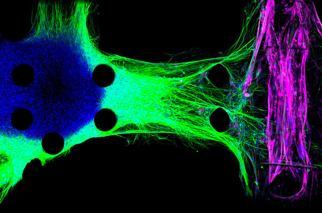 model of the neuromuscular junction using motor neurons derived from ALS patients